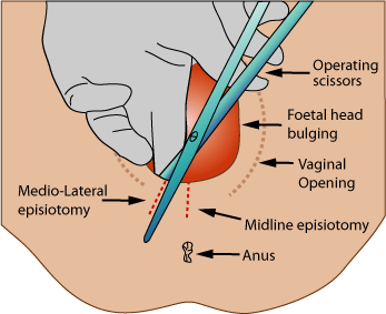 vaginal tearing during sex