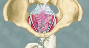 transvaginal mesh bladder sling surgery